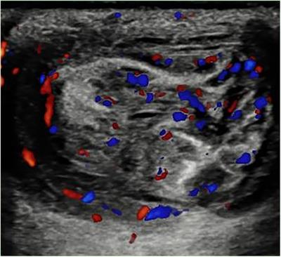 Case Report: The acute appendicitis and incarcerated umbilical hernia: a rare association